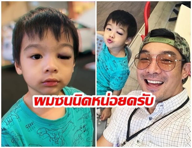 น้องโอลาฟ ลูกชาย โอ๊ต วรวุฒิ ตกจากที่สูง ตาบวมช้ำ