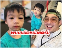 น้องโอลาฟ ลูกชาย โอ๊ต วรวุฒิ ตกจากที่สูง ตาบวมช้ำ