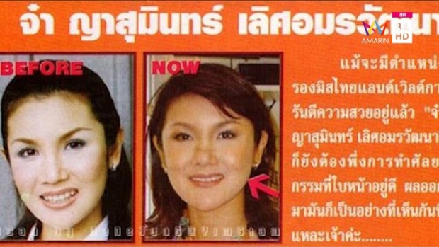 “จ๋า ญาสุมินทร์” เครียด! ถูกปลดจากรายการแบบฟ้าผ่า คนตราหน้าว่า หน้าเน่าเพราะพิษศัลยกรรม!