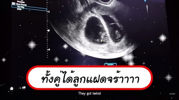 ไขข้อสงสัย! เครื่องมือใช้อัลตราซาวด์ลูก มาร์กี้-ป๊อก สิ่งนี้มีไว้ทำอะไร?!