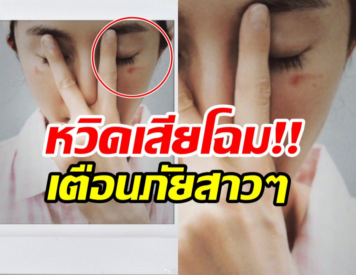 ซุปตาร์สาว เตือนภัยสายบิวตี้ หลังโดน มาส์กตาไอน้ำลวกจนผิวไหม้