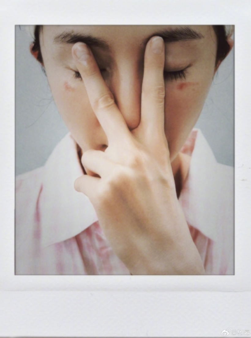 ซุปตาร์สาว เตือนภัยสายบิวตี้ หลังโดน มาส์กตาไอน้ำลวกจนผิวไหม้