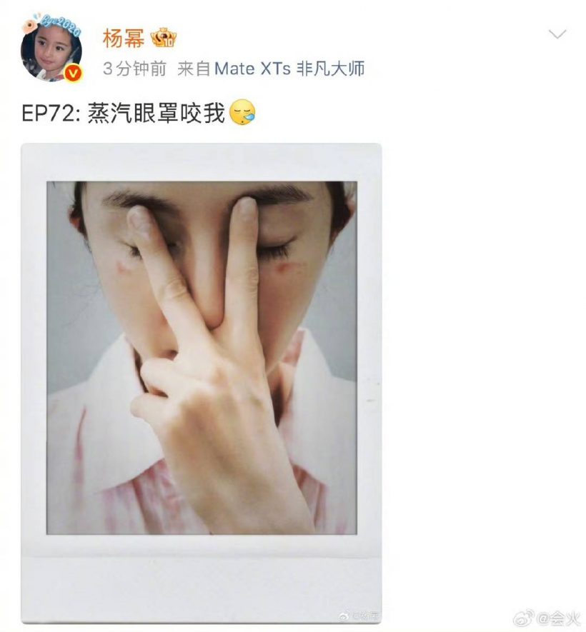 ซุปตาร์สาว เตือนภัยสายบิวตี้ หลังโดน มาส์กตาไอน้ำลวกจนผิวไหม้