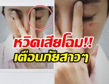 ซุปตาร์สาว เตือนภัยสายบิวตี้ หลังโดน มาส์กตาไอน้ำลวกจนผิวไหม้