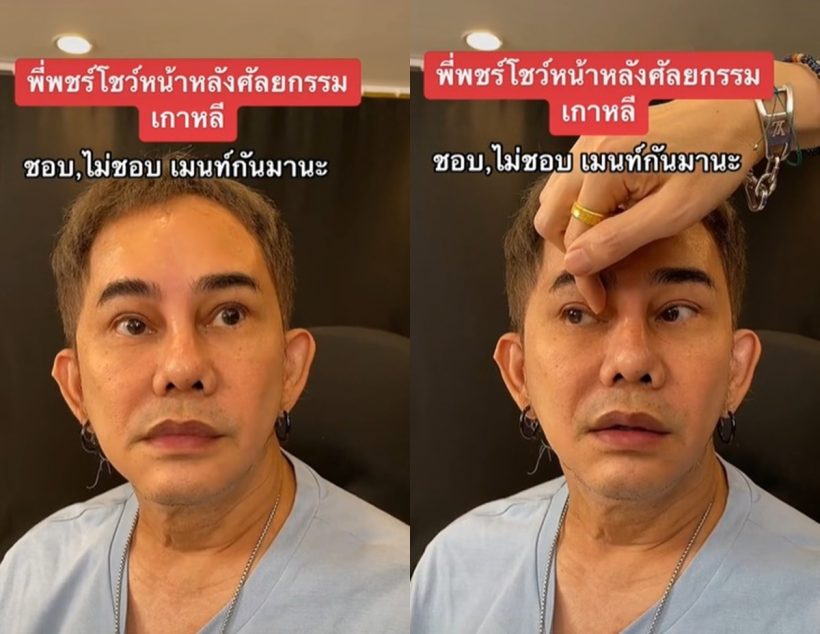 พชร์ อานนท์ โชว์หน้าสดหลังศัลยกรรม ถูกทักคล้ายดาราหนุ่มคนนี้!?