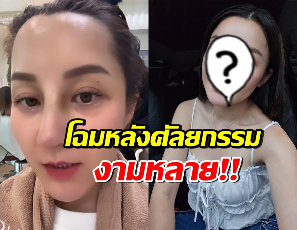 เปิดหน้าล่าสุด เอ็ม บุษราคัม หลังทำจมูก-หน้าผากครบปีครึ่งแล้ว