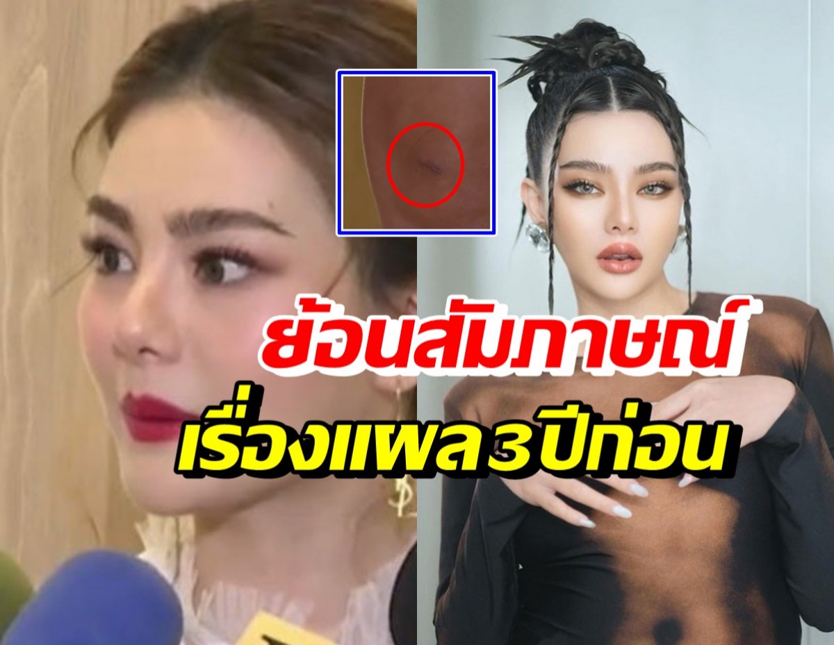 ย้อนฟังสัมภาษณ์ ดิว อริสรา เย็บหน้าเย็บหัวเข่า เพราะเหตุนี้?