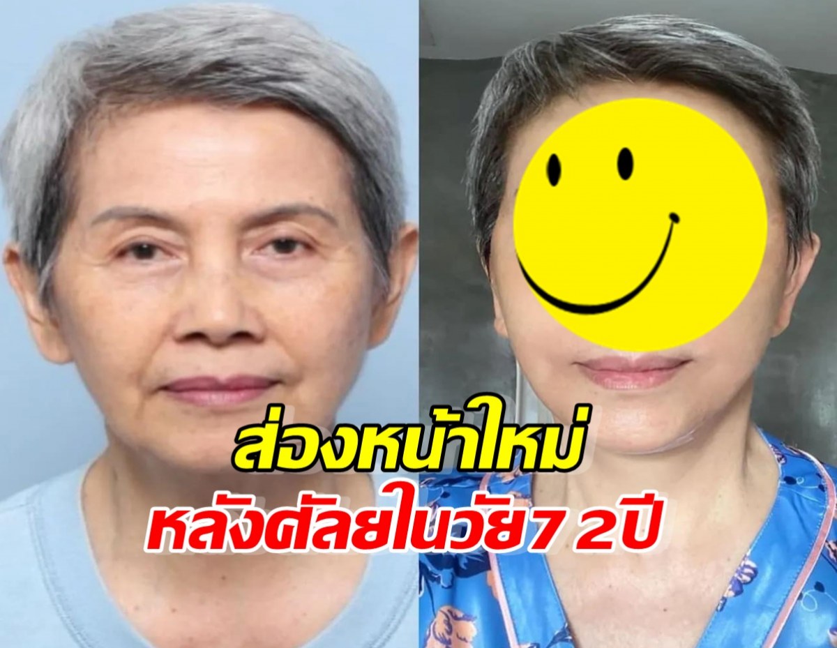 ส่องหน้าใหม่ดารารุ่นใหญ่  โย ทัศน์วรรณ หลังทำศัลยในวัย72ปี