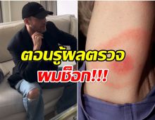 เเฟนๆส่งกำลังใจ! นักร้องหนุ่มเเจ้งข่าวร้าย ป่วยโรคไลม์