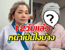 ตั๊กแตนเปิดหน้าหลังศัลยกรรม 12 วัน เมินคนแซะใส่ฟิลเตอร์