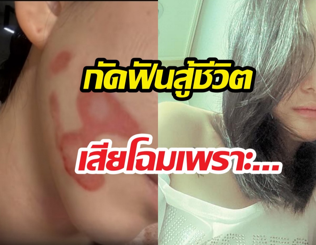 ดาราสาว เผยรอยแผลหน้าเสียโฉม ไม่ท้อสมัครงานหาเงินรักษา