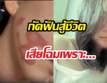 ดาราสาว เผยโฉมหลังหน้าเสียโฉม ไม่ท้อสมัครงานหาเงินรักษา