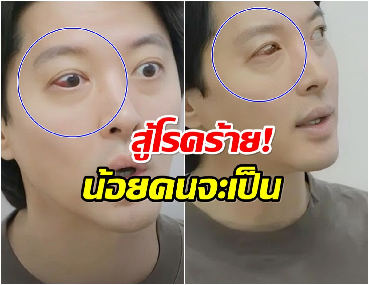 แฟนๆใจหาย พระเอกดังตรวจพบโรคหายาก ใบหน้าเริ่มเปลี่ยน!
