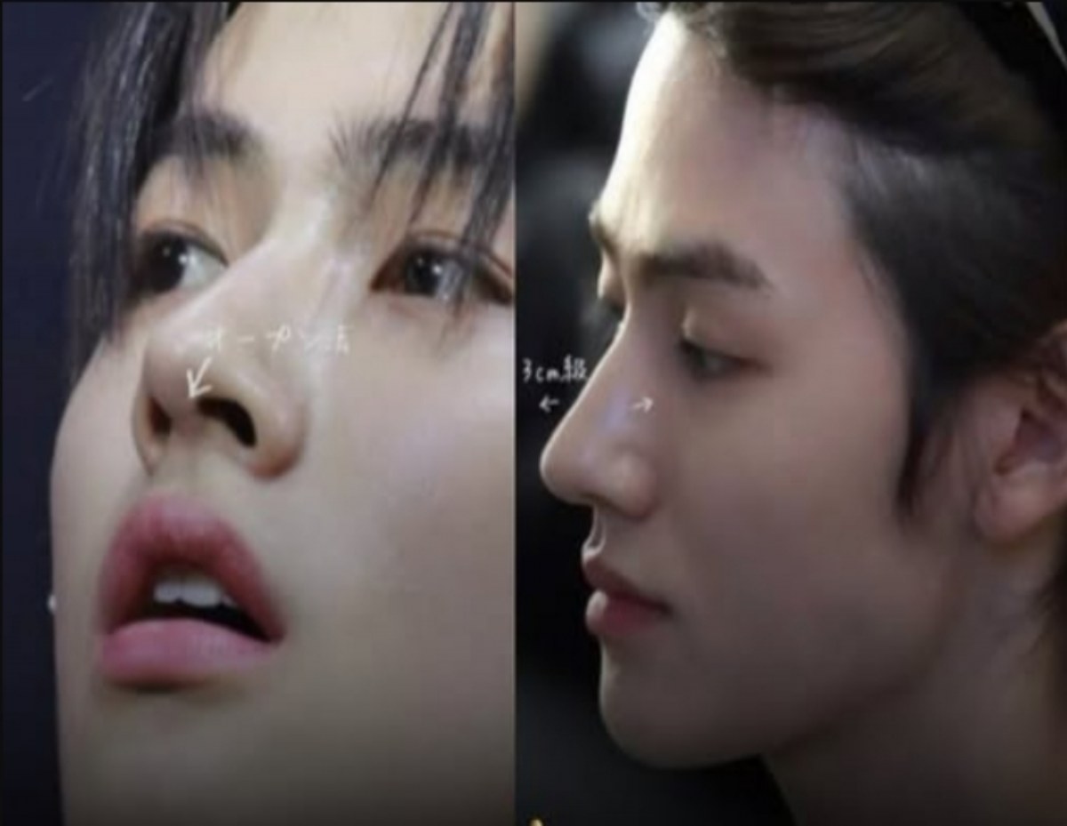 ความลับใต้ดั้งพุ่งหนุ่มคนดัง? ชาวเน็ตอ้างเจอแผลศัลยฯ