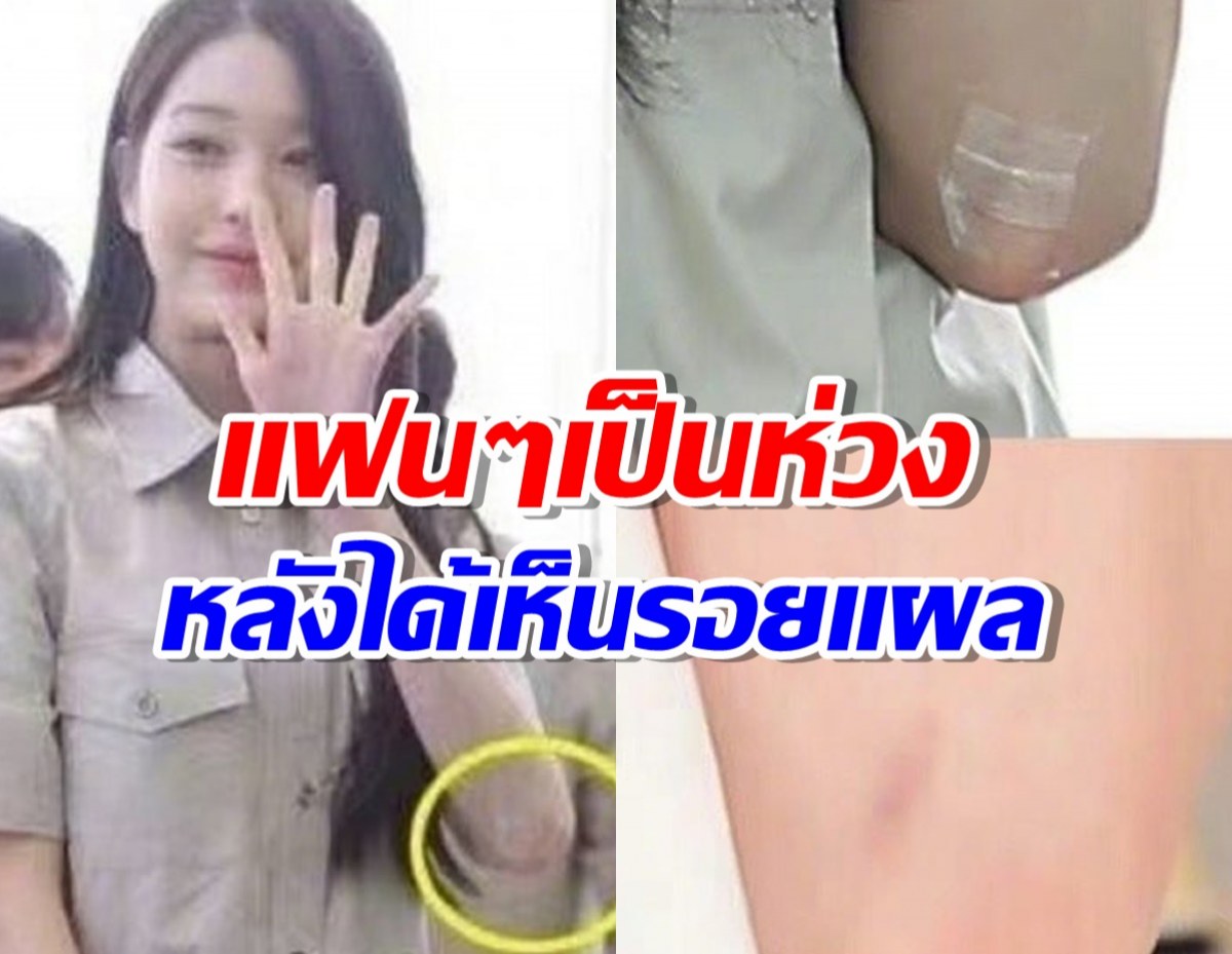 ชาวเน็ตตกใจที่ได้เห็นแขนวอนยอง IVE บาดเจ็บจนเย็บ7เข็ม