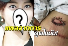  นางเอกดัง โพสต์แผลจากการดูดไขมันที่ผิดพลาดโชว์ สยองมาก!