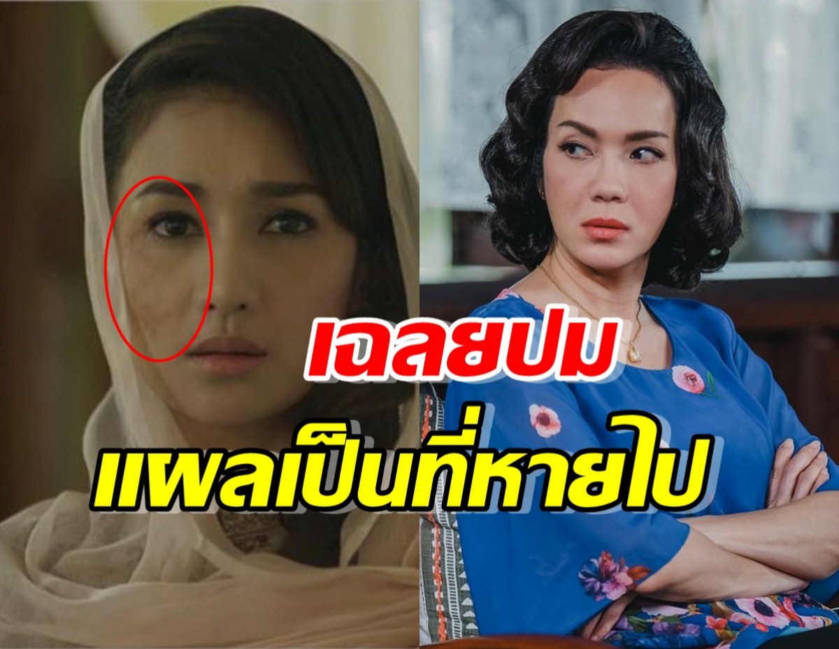 เฉลยแล้ว ทำไมมารตี ในขวัญฤทัย ไร้แผลเป็นน้ำกรดสาด