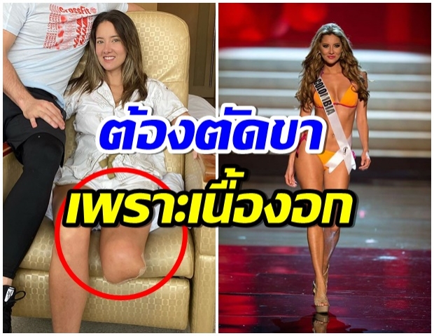 นางเเบบสาว โคลอมเบีย  ต้องสูญเสียขา หลังตรวจพบเนื้อร้าย 