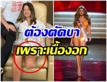 นางเเบบสาว โคลอมเบีย  ต้องสูญเสียขา หลังตรวจพบเนื้อร้าย