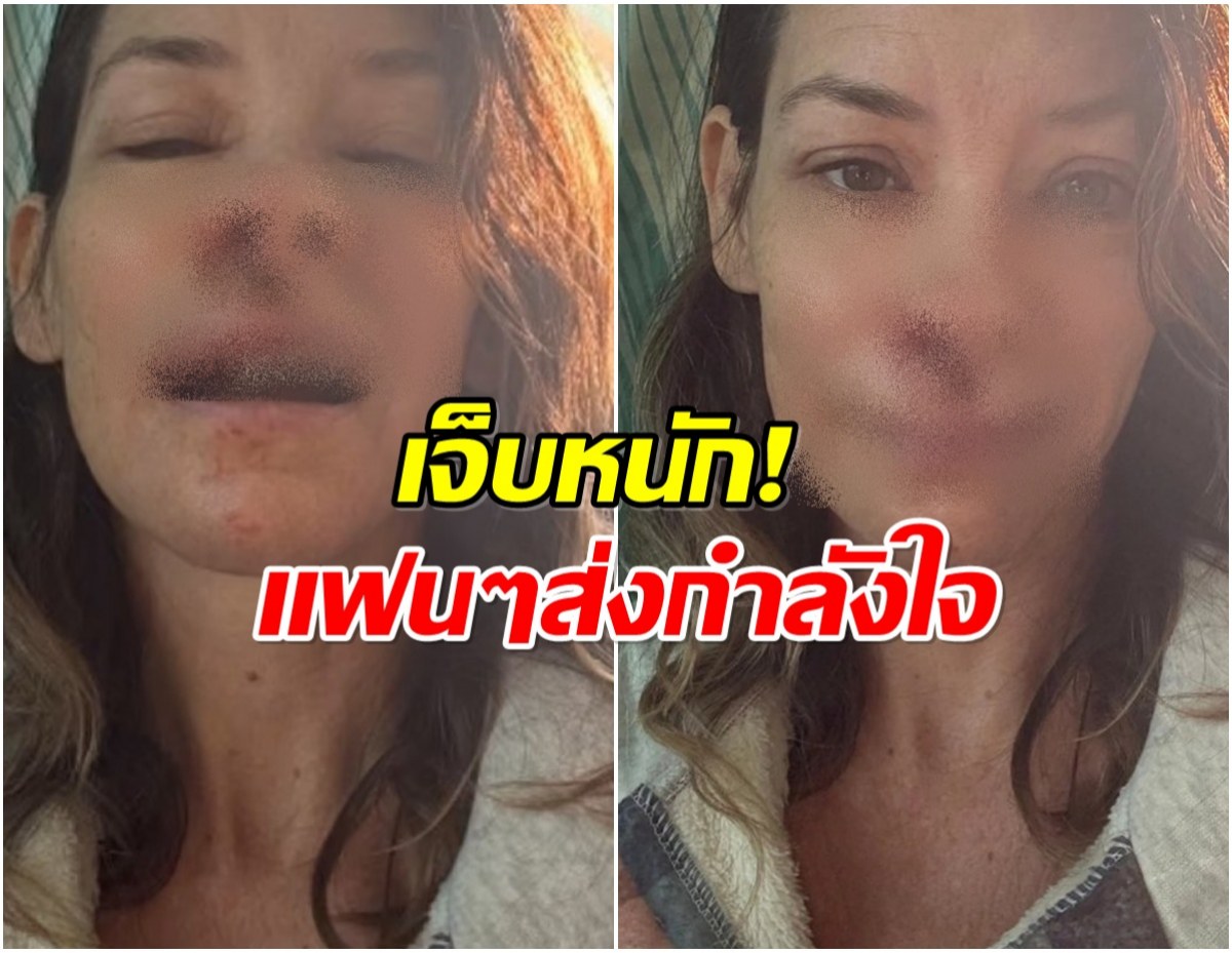 วูบกลางหาด! นักเเสดงสาว หน้าฟาดหิน แผลชัดจนแฟนตกใจ