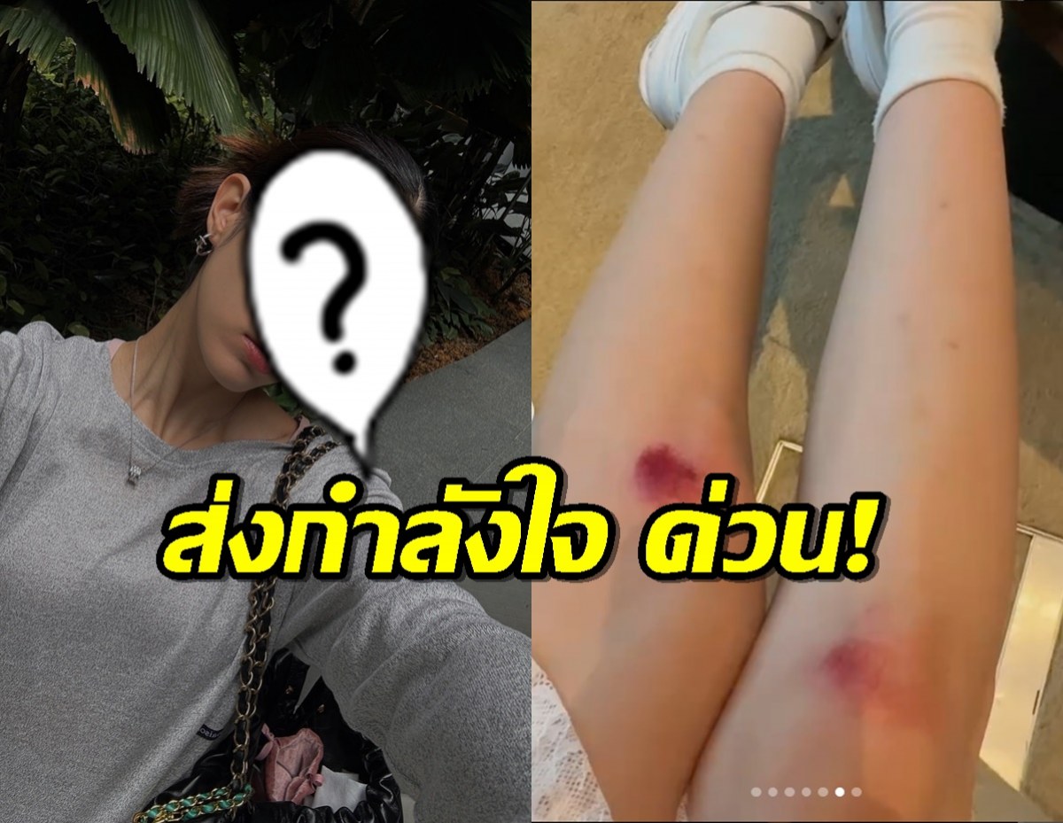 ส่งกำลังใจ นักแสดงสาวหน้านิ่ง เกิดอุบัติเหตุขณะเที่ยวทริปสิงคโปร์