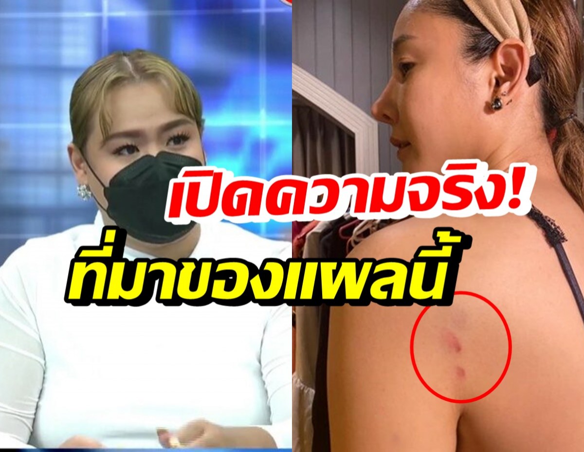 ฮิปโป พูดแล้ว ภาพบาดแผลไหล่ซ้ายแตงโม เกิดจากอะไร?