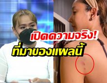 ฮิปโป พูดแล้ว ภาพบาดแผลไหล่ซ้ายแตงโม เกิดจากอะไร?