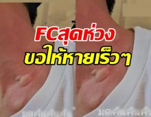 FCสุดห่วง..พระเอกดังแชร์ภาพต้นคอแดงเถือกมีเม็ดตุ่มขึ้น