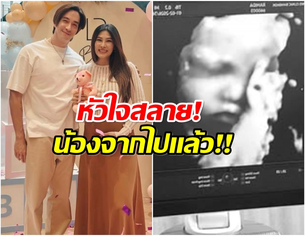 เศร้า นุ่น-หลุยส์ หัวใจเเตกสลาย สูญเสียลูกสาวในท้อง!