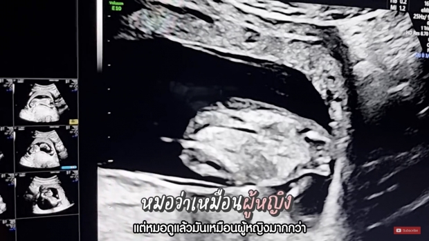 ก้อย ท้า ตูน วาง 1 ล้านทายเพศลูก สุดลุ้น! เมื่อหมอบอกว่า...?