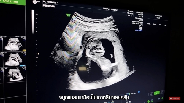 ก้อย ท้า ตูน วาง 1 ล้านทายเพศลูก สุดลุ้น! เมื่อหมอบอกว่า...?