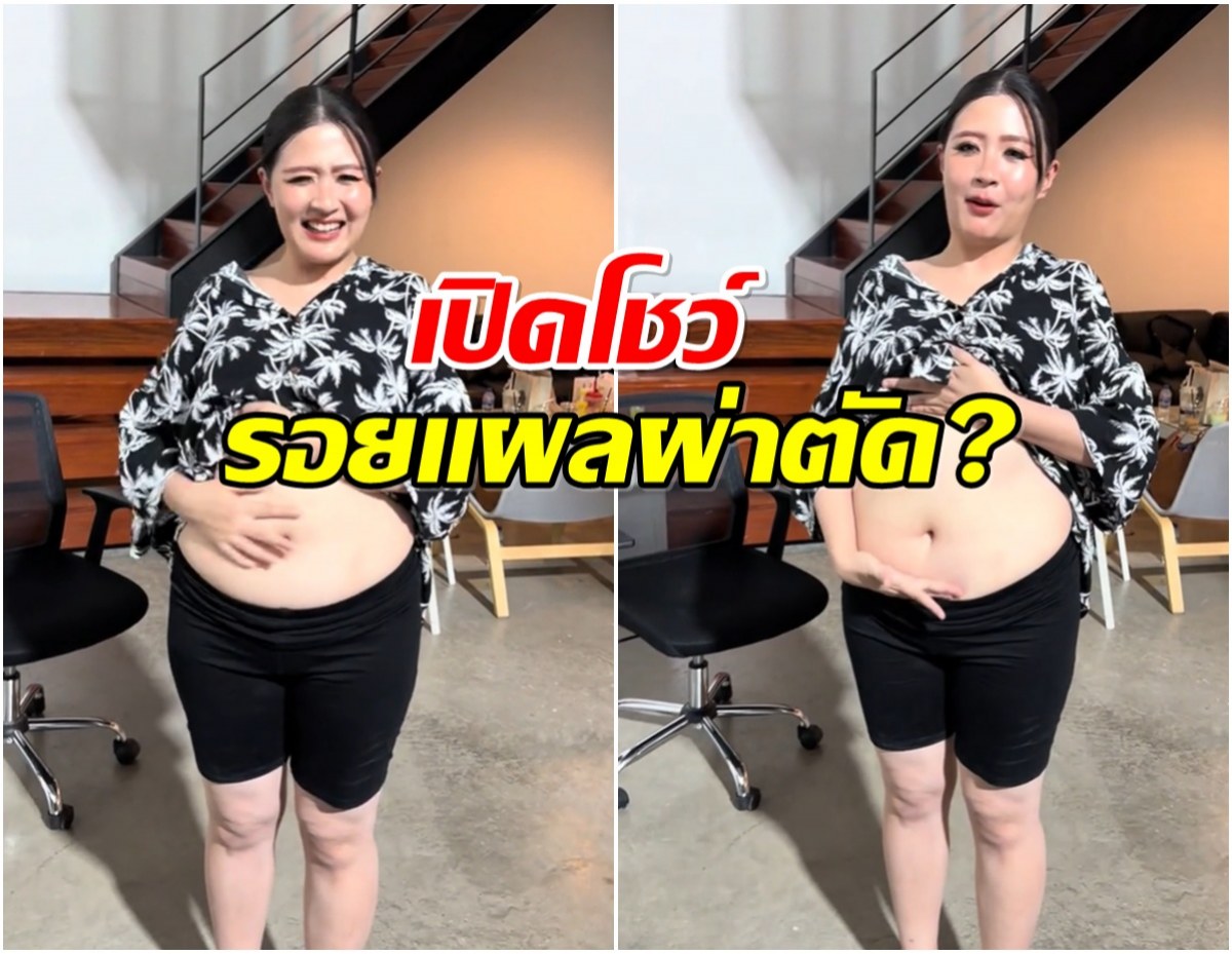 โฟกัส จีระกุล เฉลย ที่ผอมลงเร็วเพราะผ่าตัดกระเพาะ?