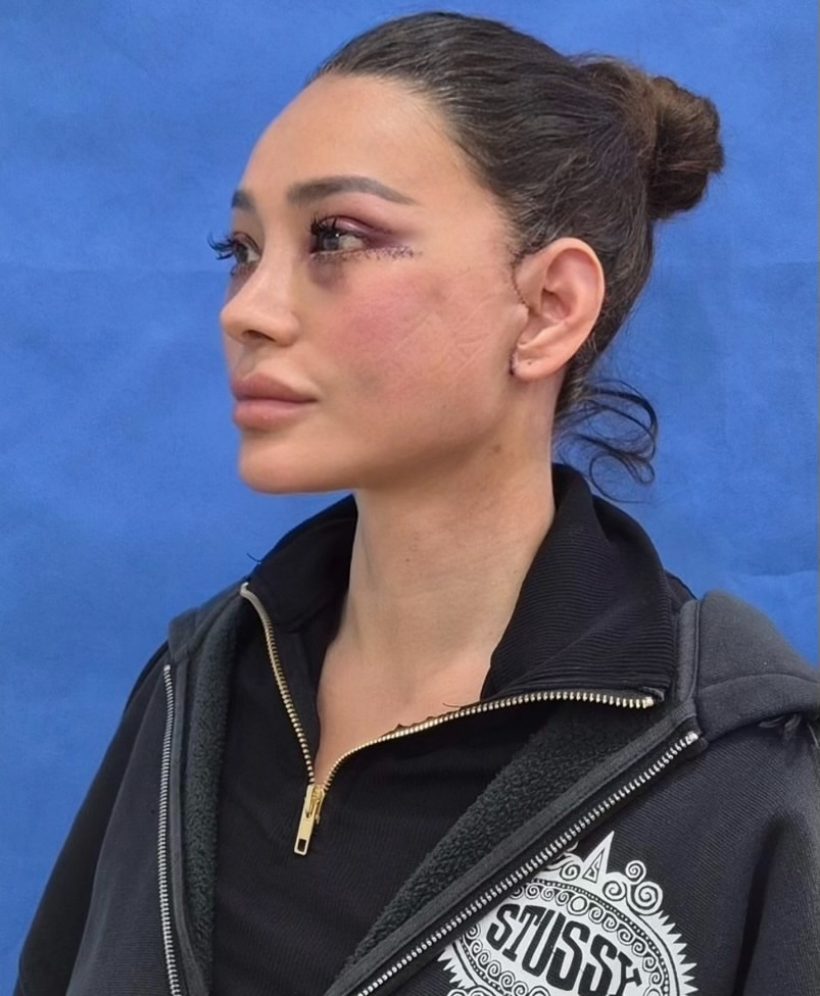 เปิดหมดไม่มีกั๊ก! โย ยศวดี เล่าประสบการณ์ดึงหน้า คุ้มค่าทุกบาท