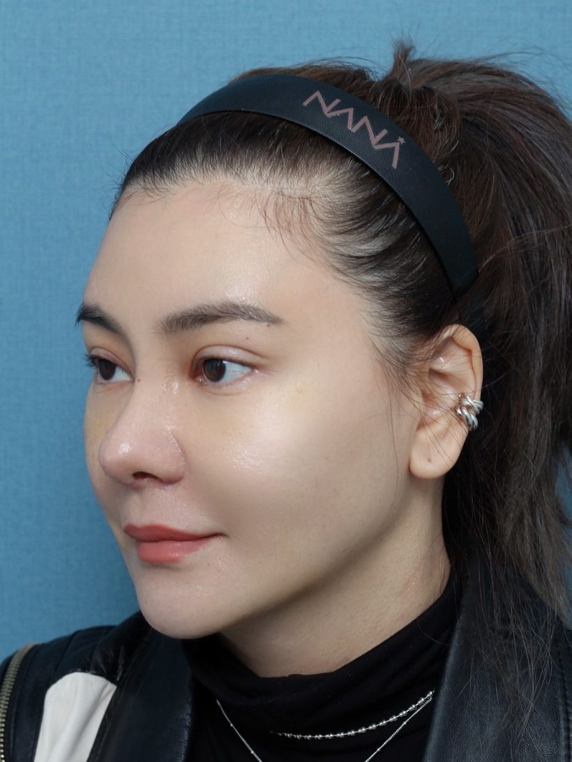 ซูมดูให้ชัด! หน้าใหม่ โอ๋ ภัคจีรา หลังเสริมดั้งครบ 7 วัน