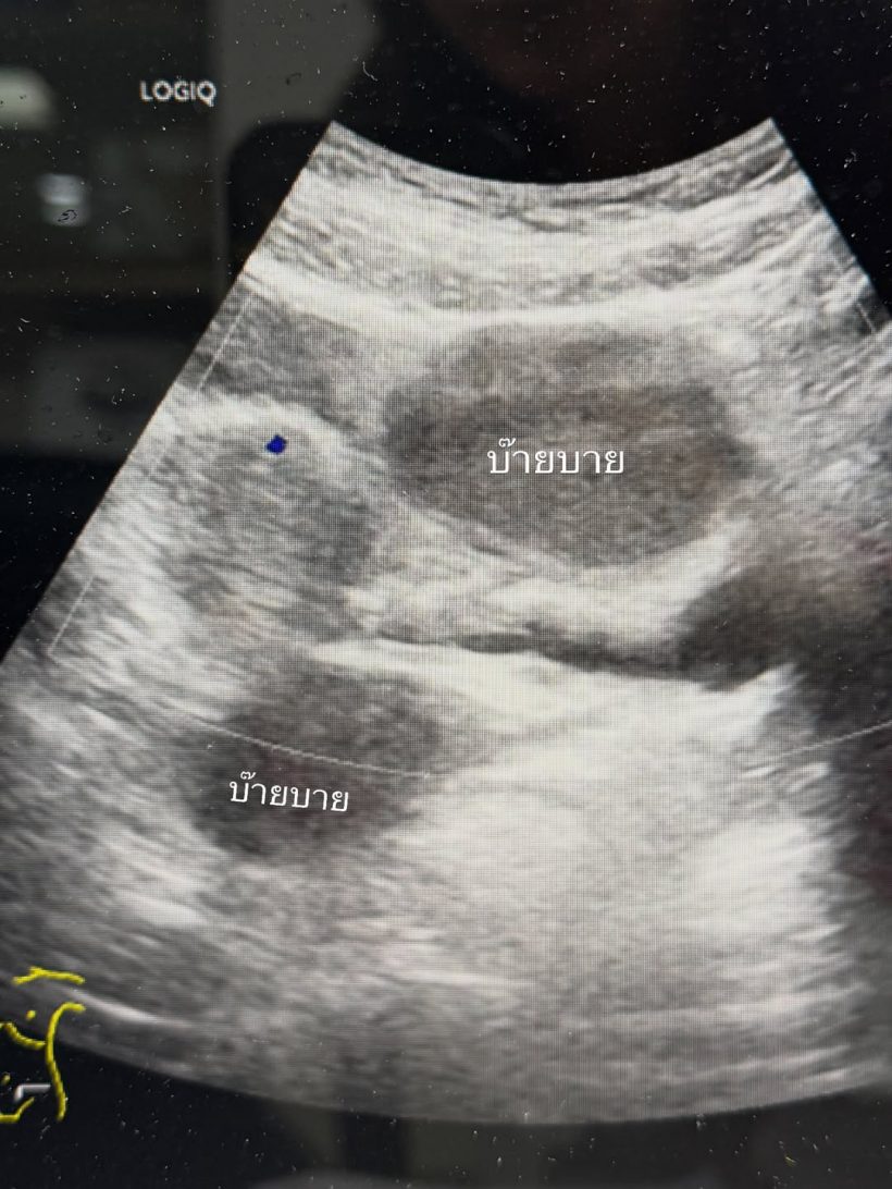 ตกใจ! จ๊ะจ๋า พริมรตา ตรวจเจอโรคที่ไม่คาดคิด ต้องผ่าตัด