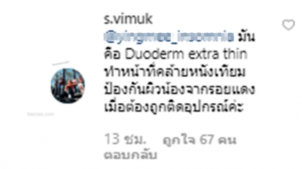 โอเคเคลียร์!..ในที่สุดก็ได้รู้ว่าแผ่นที่แปะหน้าน้องแฝด มิก้า-มิย่า คืออะไร หายสงสัยสักที!