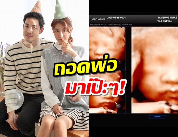 อ้วน รังสิต โชว์ภาพอัลตร้าซาวน์ลูกคนแรก ถอดแบบพ่อมาชัดๆ 