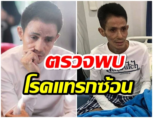 โรเบิร์ต สายควันหายป่วยมะเร็งแล้ว แต่ตรวจพบเจอวัณโรคปอด-รักษาอยู่ ICU