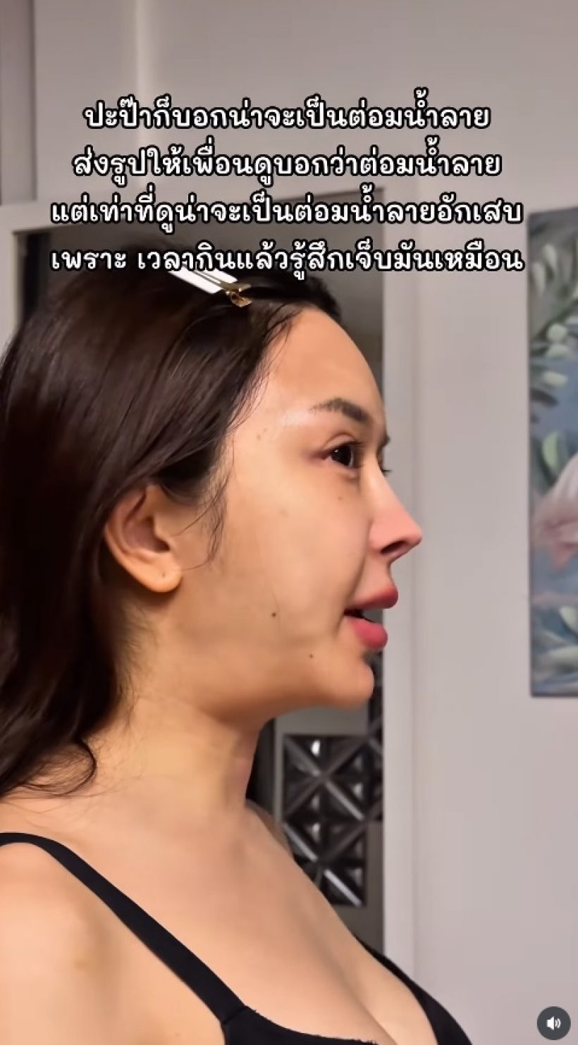 หญิงแย้คางบวม ถูกทักคล้ายมะเร็ง ล่าสุดหมอฟันธง เป็นอะไร?
