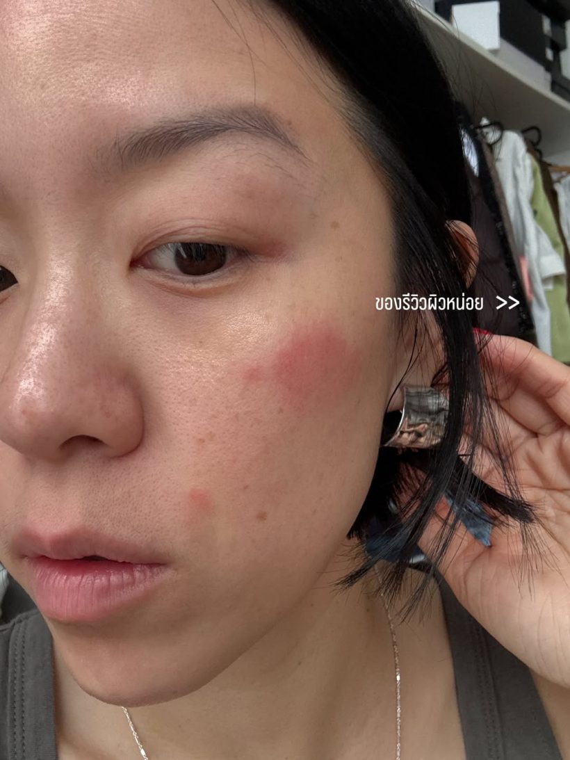 พลอย หอวัง พลีชีพเผยหน้าสด ผื่นขึ้นหน้าหนัก แต่ยังสวย!