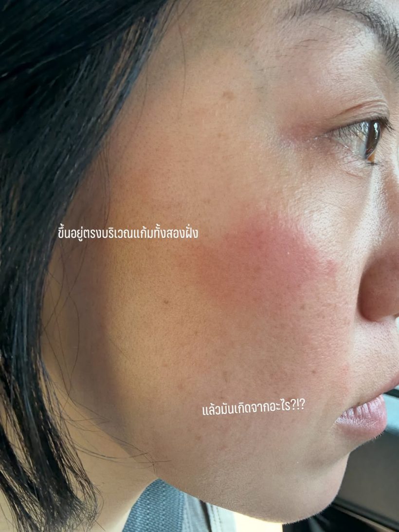 พลอย หอวัง พลีชีพเผยหน้าสด ผื่นขึ้นหน้าหนัก แต่ยังสวย!