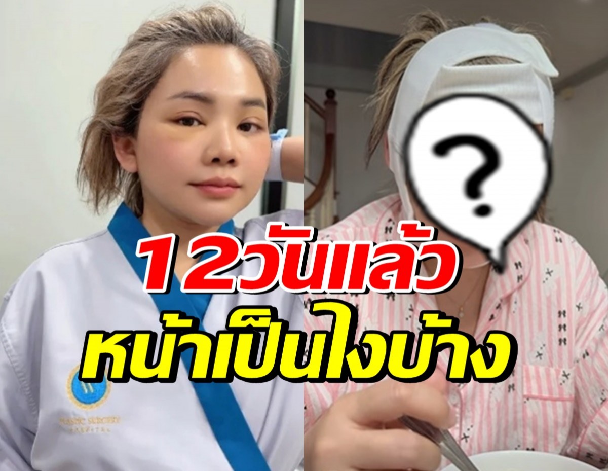 ตั๊กแตนเปิดหน้าหลังศัลยกรรม 12 วัน เมินคนแซะใส่ฟิลเตอร์