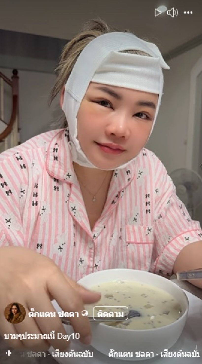 ตั๊กแตนเปิดหน้าหลังศัลยกรรม 12 วัน เมินคนแซะใส่ฟิลเตอร์