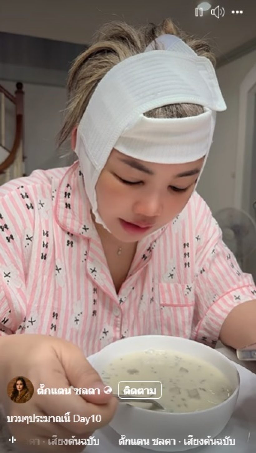 ตั๊กแตนเปิดหน้าหลังศัลยกรรม 12 วัน เมินคนแซะใส่ฟิลเตอร์