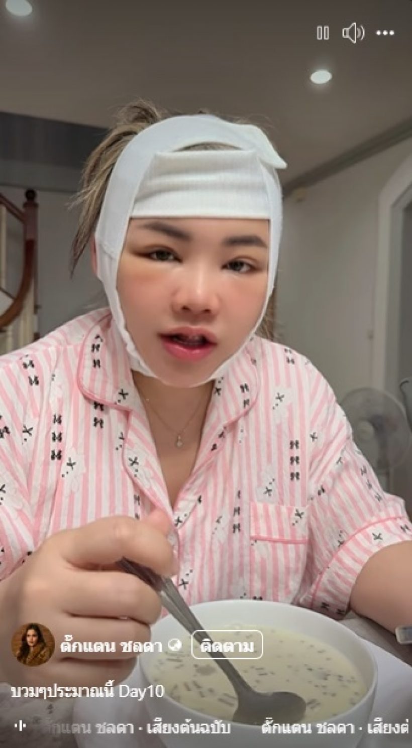 ตั๊กแตนเปิดหน้าหลังศัลยกรรม 12 วัน เมินคนแซะใส่ฟิลเตอร์