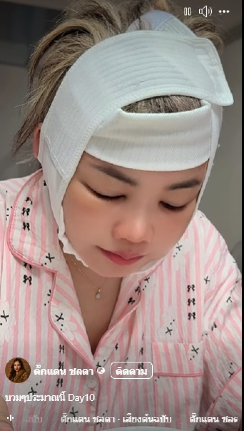 ตั๊กแตนเปิดหน้าหลังศัลยกรรม 12 วัน เมินคนแซะใส่ฟิลเตอร์