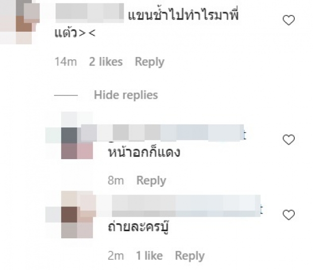 ชาวเน็ตขี้สงสัย! เเเห่ถาม เเต้ว เเขน-คอ เขียวช้ำ ไปโดนอะไรมา 