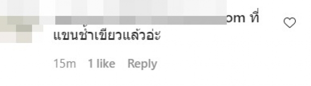 ชาวเน็ตขี้สงสัย! เเเห่ถาม เเต้ว เเขน-คอ เขียวช้ำ ไปโดนอะไรมา 