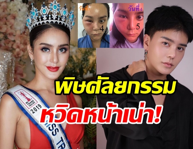 ช็อก! มิสทรานยูนิเวิร์สไทยแลนด์ ศัลยกรรมทำพิษ หวิดหน้าเน่า!