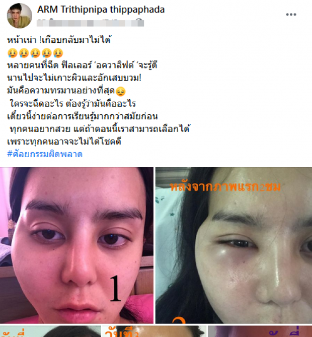 ช็อก! มิสทรานยูนิเวิร์สไทยแลนด์ ศัลยกรรมทำพิษ หวิดหน้าเน่า!